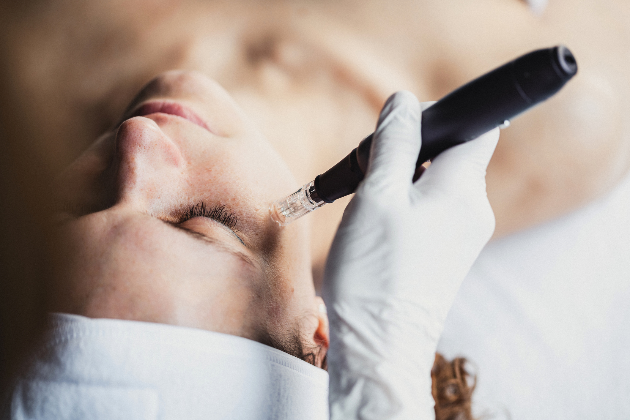 Microneedling médical à Paris Nation – stimulation cutanée et régénération de la peau
